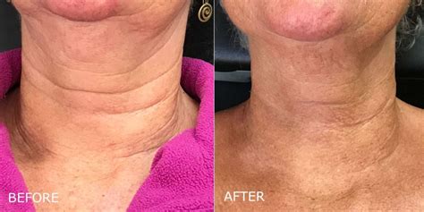 Neck Line Fillers Before & After Photos | DermMedica