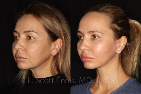 Facelift Before & After Photos by Dr. Ennis in Boca Raton