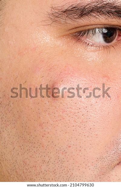 425 Sebaceous Cyst Images, Stock Photos & Vectors | Shutterstock