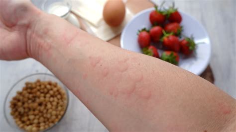 5 Food Allergy Triggers of Hives and Skin Rashes | Food Allergies Atlanta