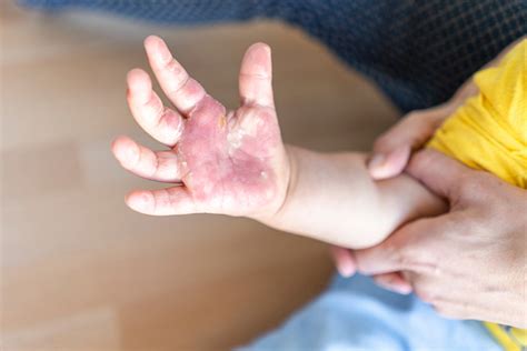 8 Treatment Options And Home Remedies For Burns In Children ...