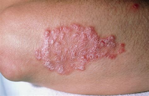 Plaque Psoriasis | Chandigarh Ayurved & Panchakarma Centre