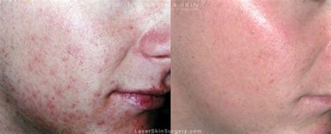 Acne & Acne Scar Treatment New York, NY | Laser Center