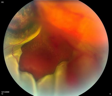 Choroidal Melanoma With Retinal Detachment - Retina Image Bank