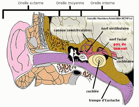 Animazione crescita neurinoma - Immagini neurinoma - neurinoma acustico