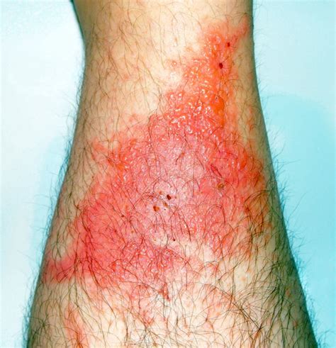 Poison Ivy Rash Causes How To Identify Poison Ivy Rash And Treatment ...