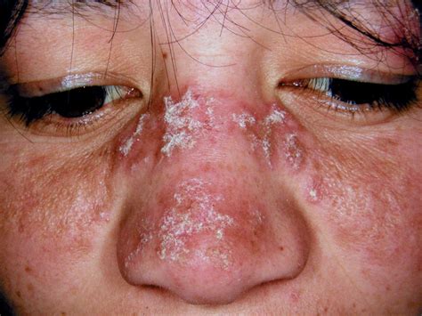 Nasal Ulcers Lupus