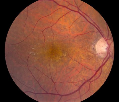 Retina showing choroidal neovascularization from wet-AMD. Clinical ...