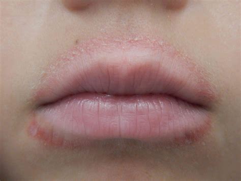 Skin Rash And Swollen Lips | Lipstutorial.org