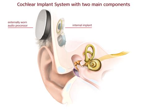 Med-El sees first procedure with fully implantable hearing system ...