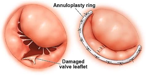 Annuloplasty - Mayo Clinic