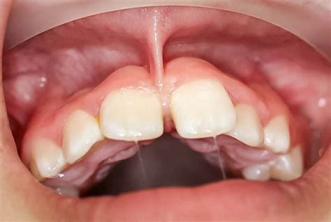 Labial Frenulum Normal