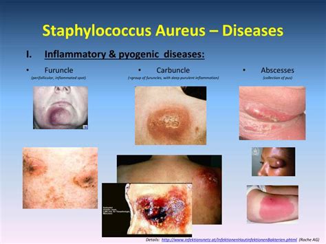 Staph Aureus Symptoms