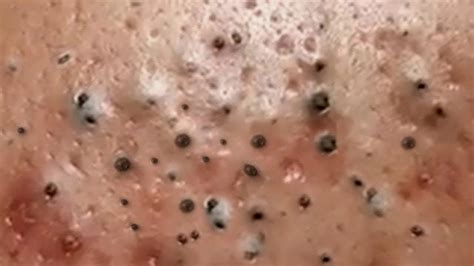 Pimple Popping Videos 2024 Blackheads Youtube Kids - December 2024 ...