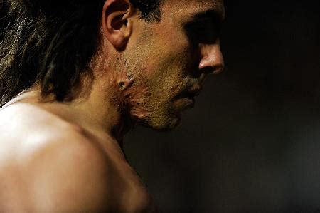 How Carlos Tevez got his Neck Scars - FootyBlog.net