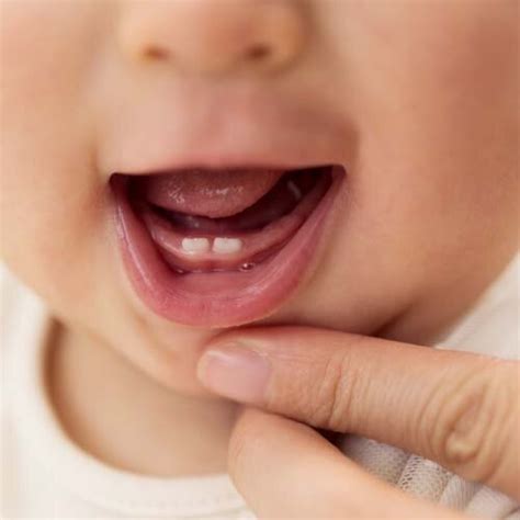 My baby's teeth are coming in crooked: What should I do? | Kowhai ...