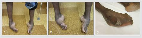 Complex foot deformities: A case study - Mayo Clinic