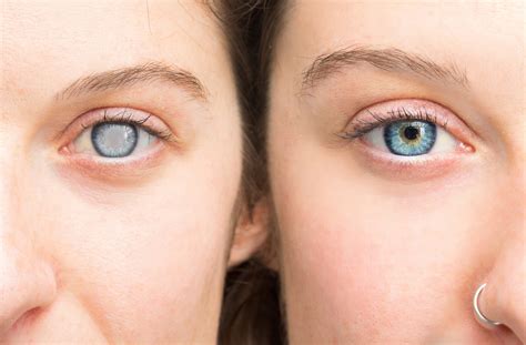 before-and-after-cataracts | Eye Effects in Calgary & Didsbury