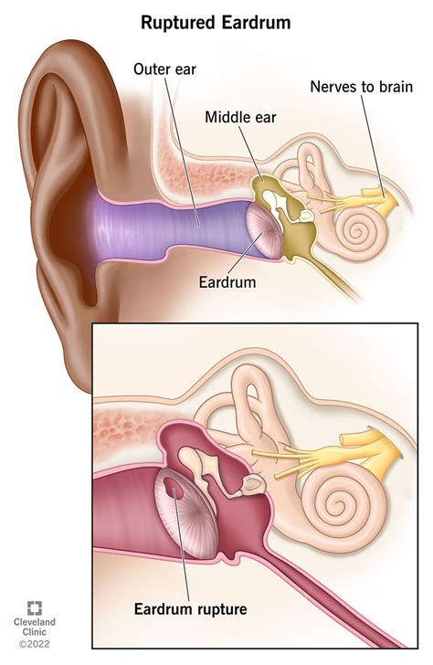 Ruptured Tympanic Membrane Trauma