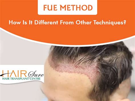 FUE Method: How Is It Different From Other Techniques? | Hair Sure