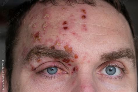 Man with Herpes Zoster (shingles) on the face, close up. Inflamed ...