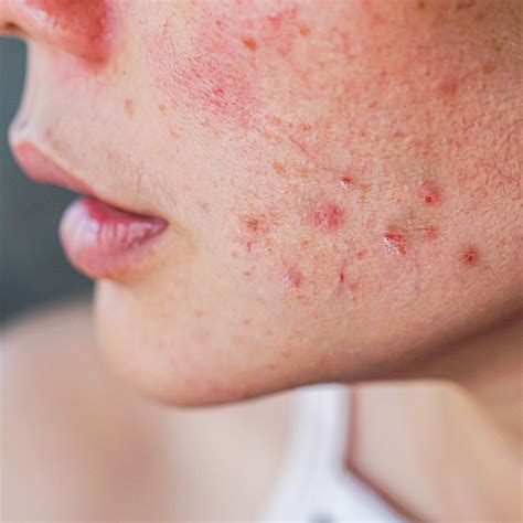 Acne Treatment Fullerton, CA - Full Spectrum Dermatology