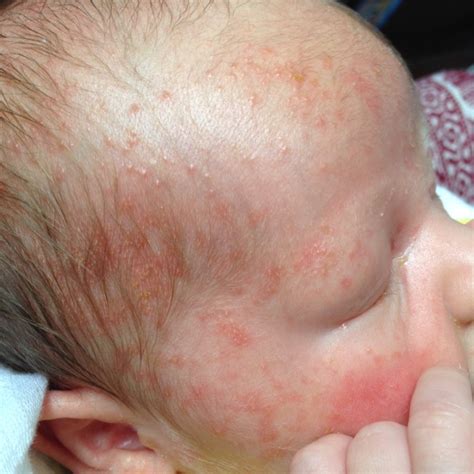 Cradle Cap? Baby Acne? Both? Please help! What to do? I've heard leave ...