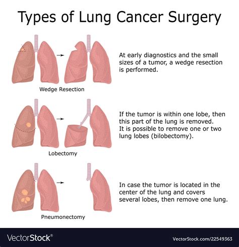 Types of lung cancer surgery Royalty Free Vector Image