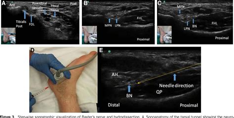 Figure 1 from Ultrasound-Guided Hydrodissection for Baxter's Neuropathy ...