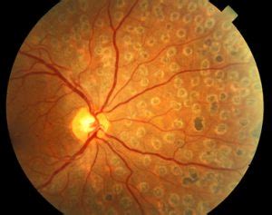 Pan-Retinal Photocoagulation | Eye Physicians and Surgeons of Ontario