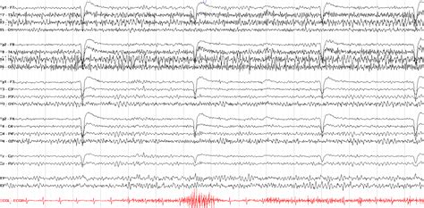 The Normal Awake EEG