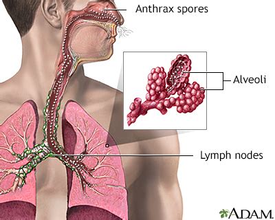 Gastrointestinal Anthrax Disease