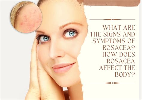 What are the signs and symptoms of Rosacea? How does Rosacea affect the ...