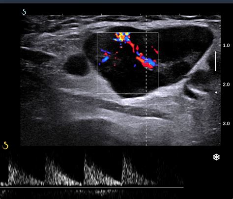 VIETNAMESE MEDIC ULTRASOUND: CASE 435: CERVICAL LYMPH NODES, Dr PHAN ...