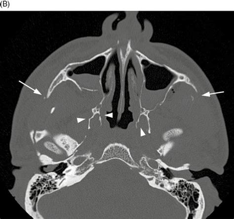 Pterygoid Plate Fracture