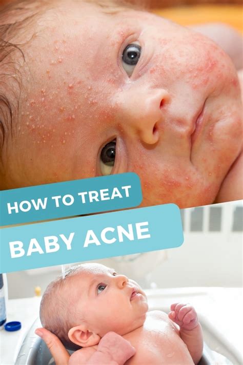 Treatment and Help for Baby Acne - Super Healthy Kids