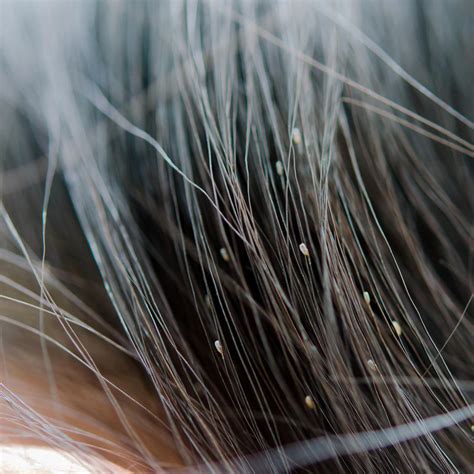 Head Lice: What Are They And How To Treat Them - howzak.com