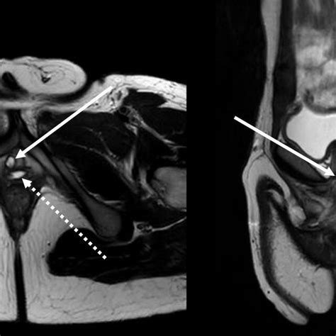 MRI demonstrating Skene's gland cyst (white solid arrow) and vaginal ...