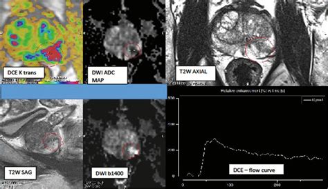 RACGP - Multiparametric MRI in the diagnosis of prostate cancer – a ...