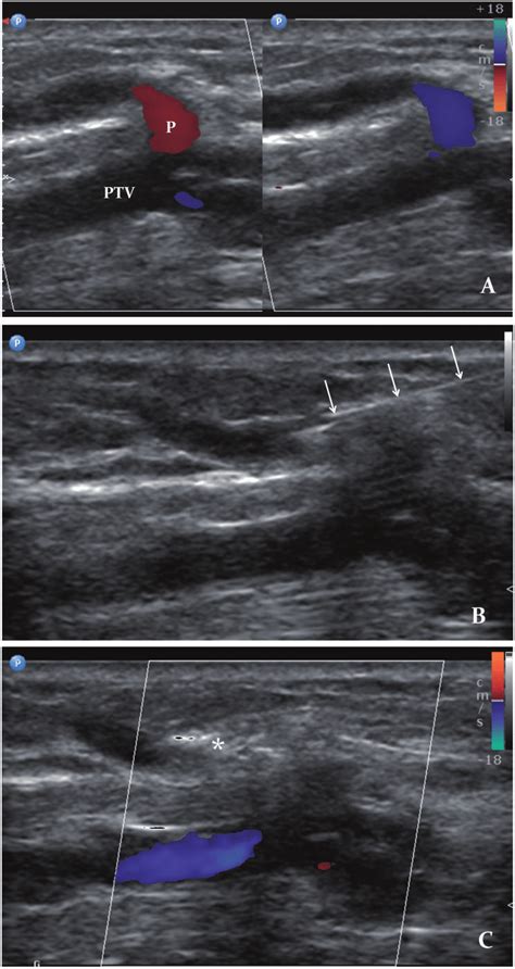 (a) Incompetent perforator (P) from posterior tibial vein (PTV) showing ...