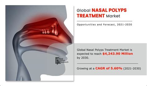 Nasal Polyps Treatment Market Size | Industry Growth, 2030