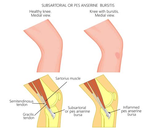 What is Pes Anserine Bursitis? | Panther Sports Medicine