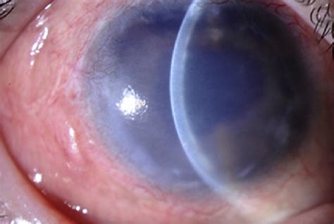 Corneal decompensation after tube implant. | Download Scientific Diagram