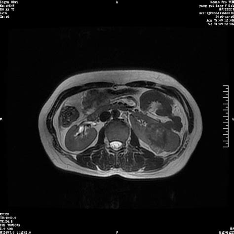 Renal Cell Carcinoma Mri