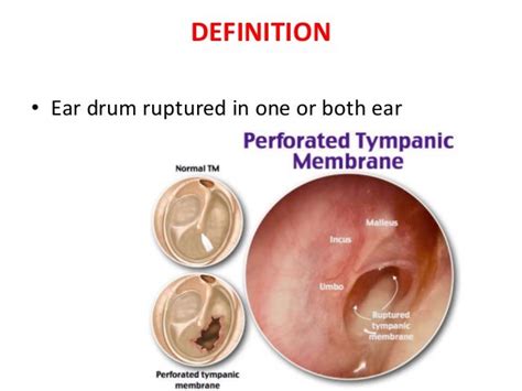 Tympanic membrane perforation