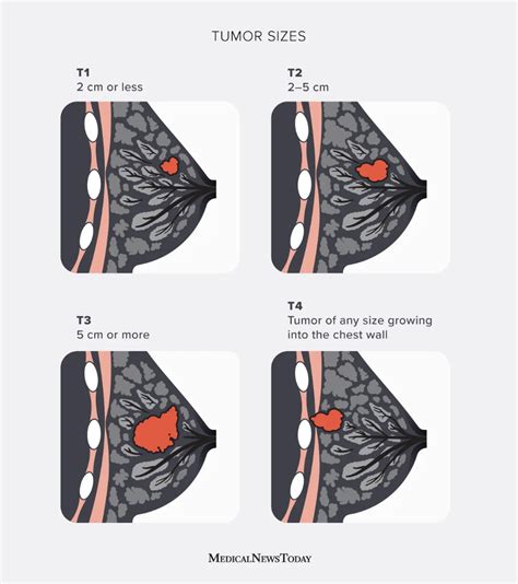 Breast cancer tumor size chart factors and more – Artofit