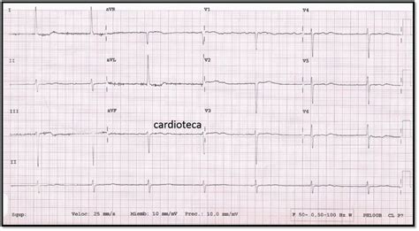 Sensación Maravilla césped fibrilacion auricular lenta Acrobacia ...