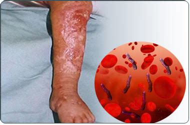 Sepsis / Septicemia-Causes-Symptoms-Treatment-Complications