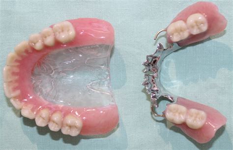 Difference Between Cast Partial Denture And Removable Partial Denture ...