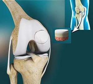 Knee Femoral Condyles